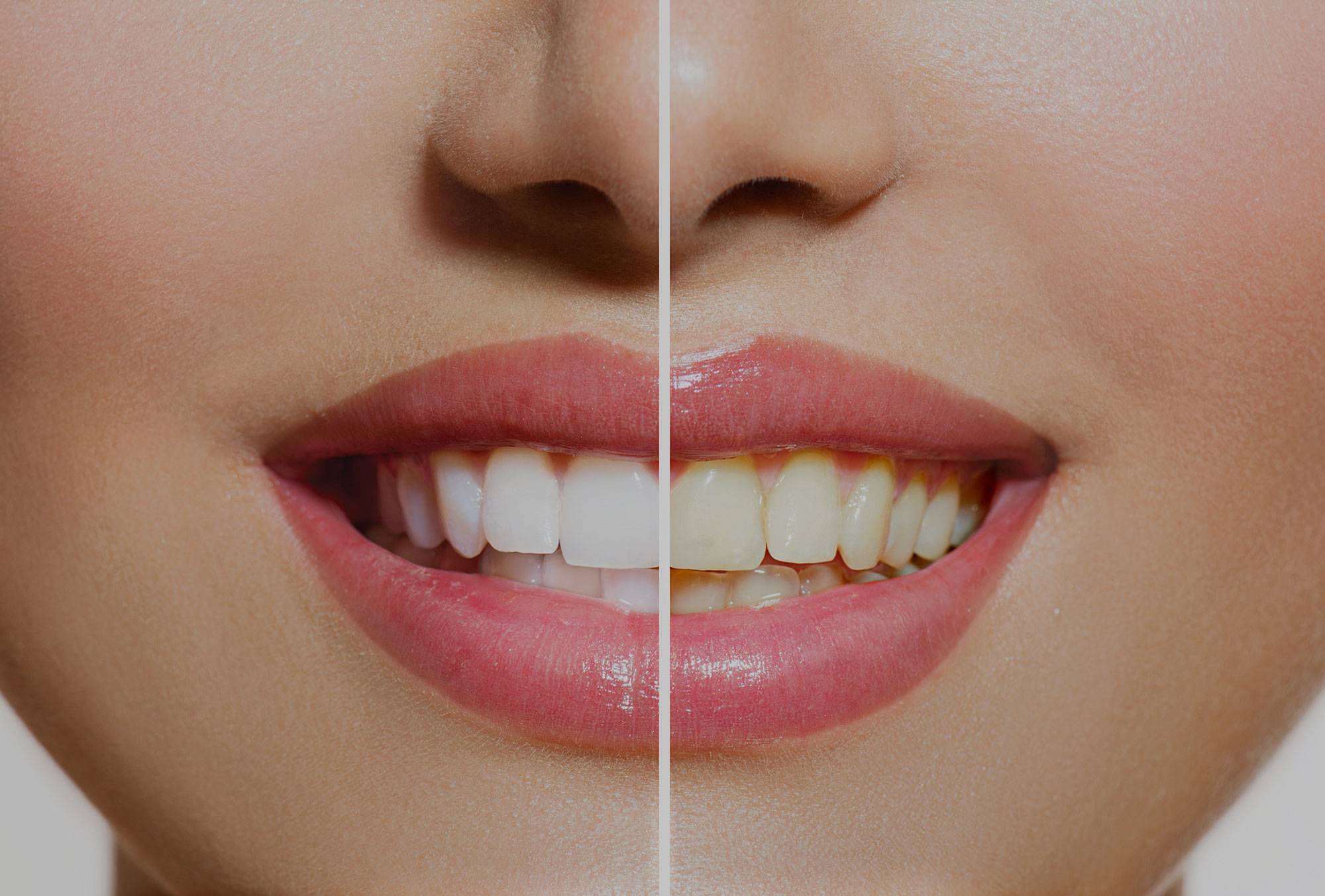 teeth whitening toronto